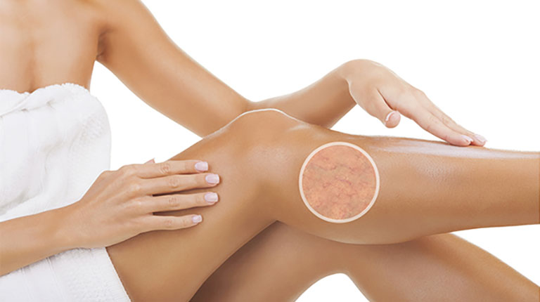 Eliminar arañas vasculares