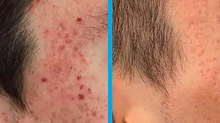 ELIMIN LESIONES BENIGNAS